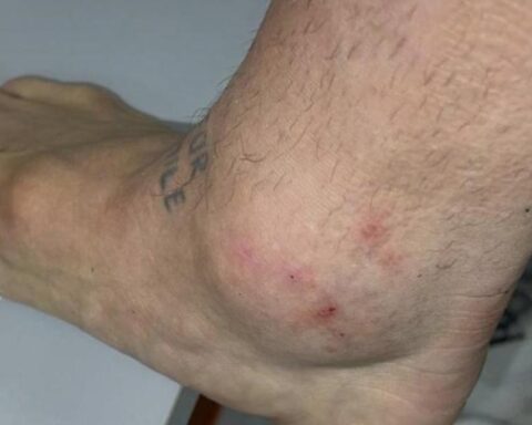 Papu Gómez's ankle, the size of a tennis ball