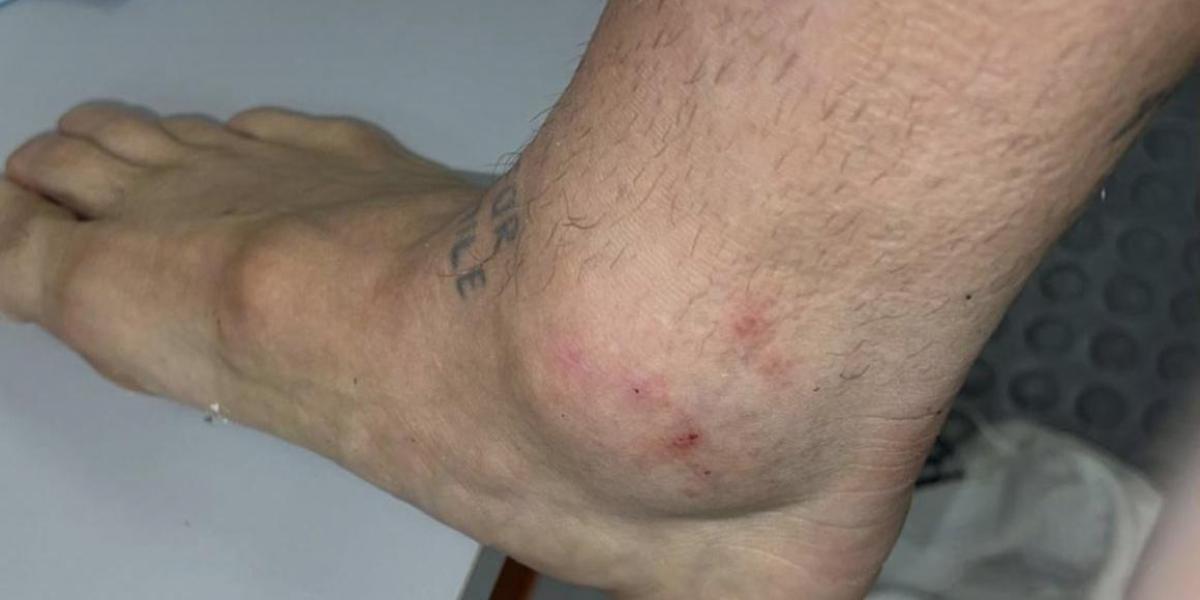 Papu Gómez's ankle, the size of a tennis ball