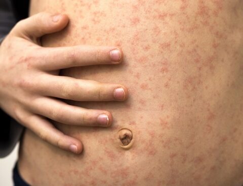 Confirmed in CABA a case of measles imported from the Middle East