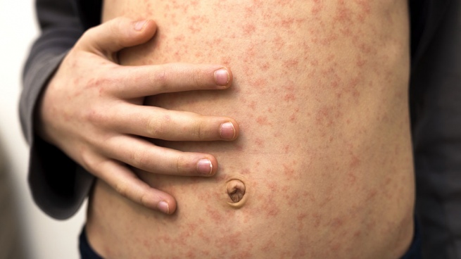 Confirmed in CABA a case of measles imported from the Middle East