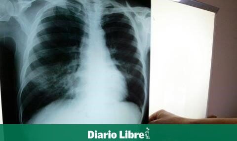 DR registers 31 cases of tuberculosis per 100 thousand inhabitants