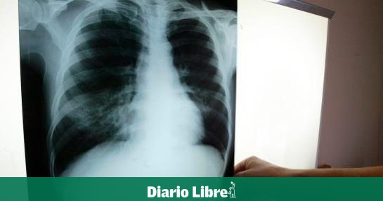 DR registers 31 cases of tuberculosis per 100 thousand inhabitants