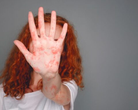 Epidemiological alert: a possible case of measles was detected in the City of Buenos Aires