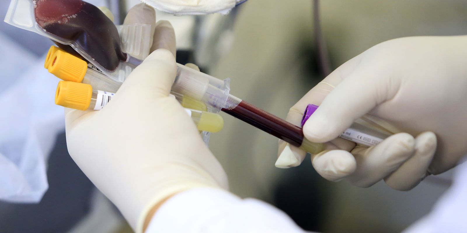 Government invested BRL 1.1 billion to treat hemophilia in 2021