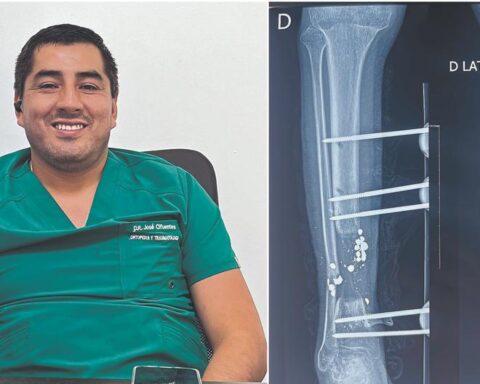 In Huancayo they perform the first "bone lengthening" surgery that allows it to grow up to 15 centimeters