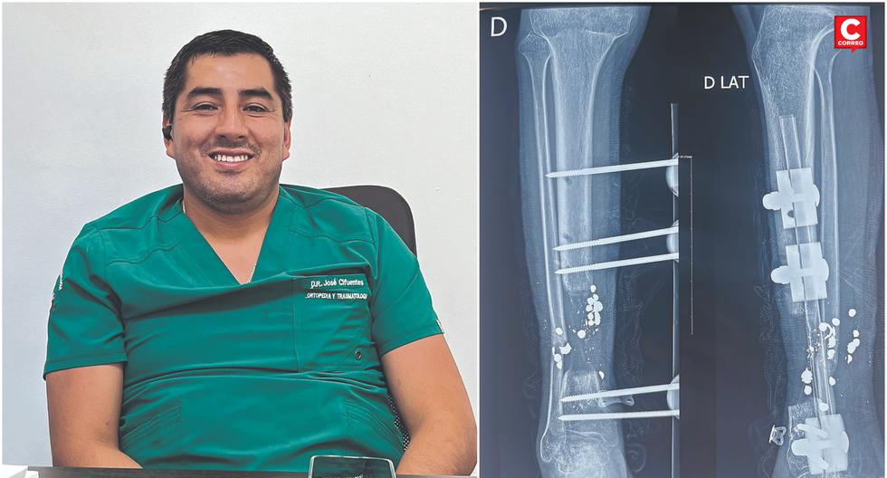 In Huancayo they perform the first "bone lengthening" surgery that allows it to grow up to 15 centimeters