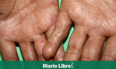 Scabies is a curable condition