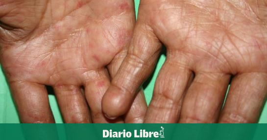 Scabies is a curable condition