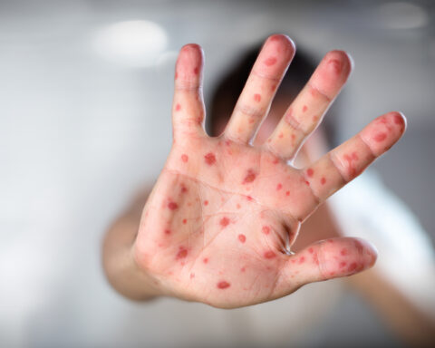 Nicaragua, under epidemiological surveillance for monkeypox