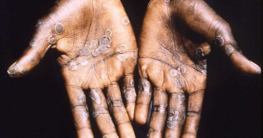 Recommendations in case of contact with patients with monkeypox