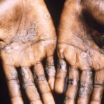 Recommendations in case of contact with patients with monkeypox