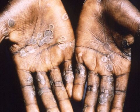 Recommendations in case of contact with patients with monkeypox