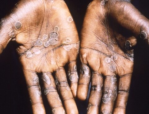 Spain detected 59 cases of monkeypox and will buy vaccines