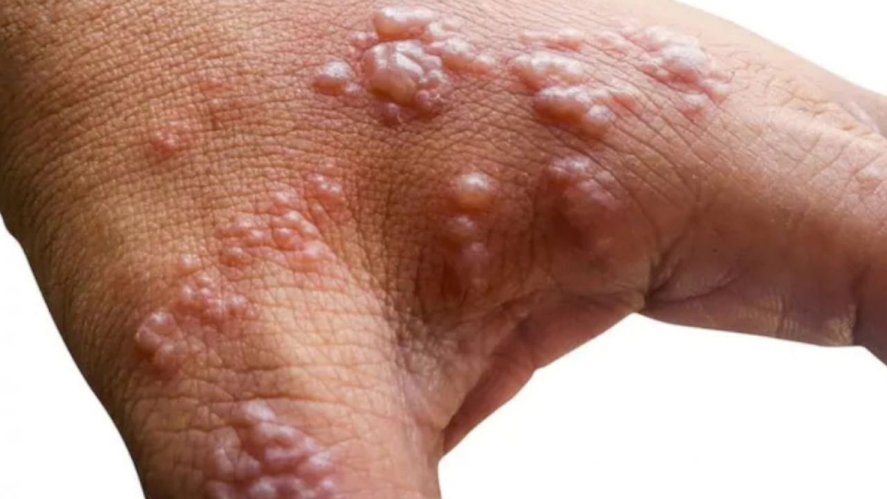 The Ministry of Health confirmed the second case of monkeypox in Argentina