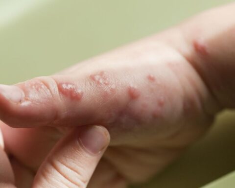 The Ministry of Health reveals new information on the suspected case of monkeypox