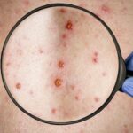 They confirm the second case of monkeypox in Argentina