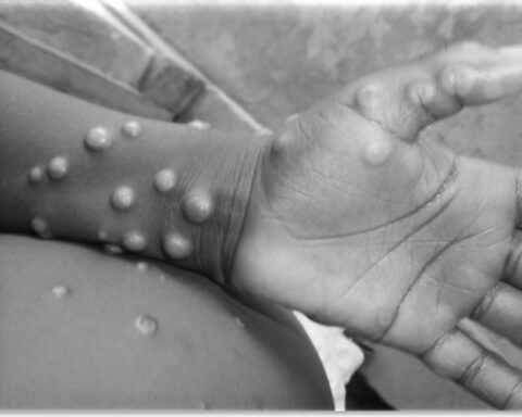 Monkeypox in Colombia: 22 people were preventively isolated in Medellín