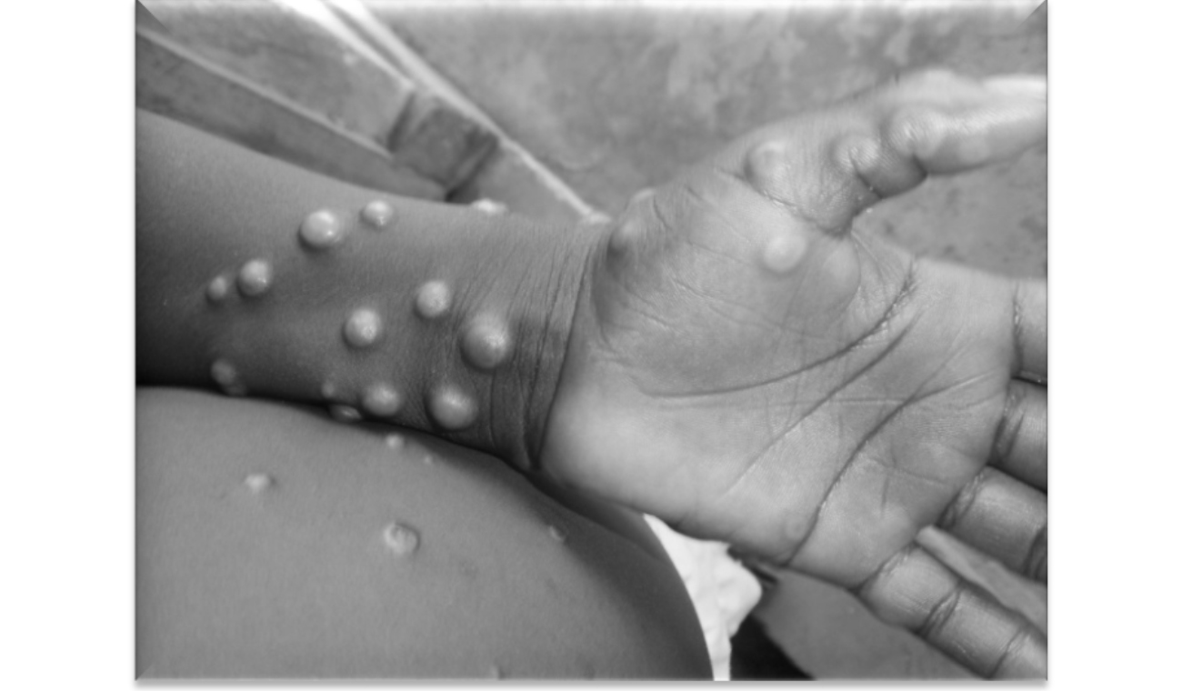 Monkeypox in Colombia: 22 people were preventively isolated in Medellín