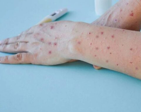 Monkeypox: the Ministry of Health confirmed the sixth case in the country