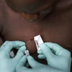 PAHO on alert due to increase in cases of monkeypox in the Americas