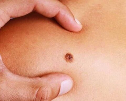 Skin cancer is the most frequent in Uruguay