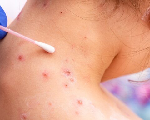 Supplies for the detection of monkeypox would only arrive next week