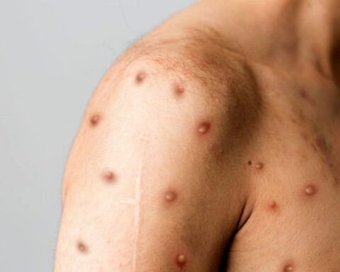 The third infected with monkeypox in the country has no travel history