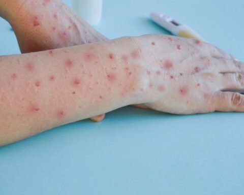 They detect the first suspected case of monkeypox in Mendoza