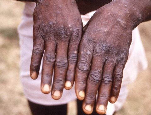 WHO seeks to change the name of monkeypox so as not to stigmatize Africans