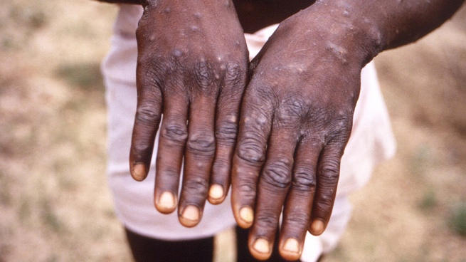 WHO seeks to change the name of monkeypox so as not to stigmatize Africans