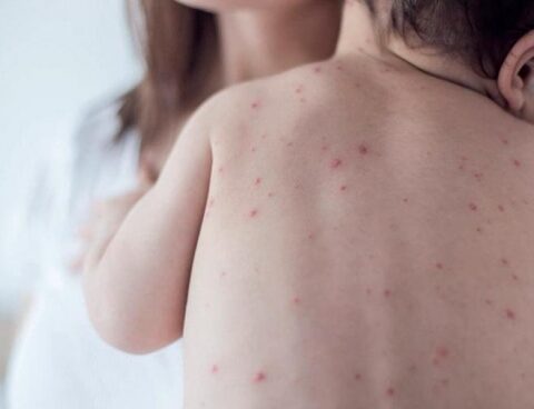 Confirmed a case of measles in the country