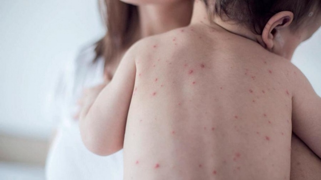 Confirmed a case of measles in the country