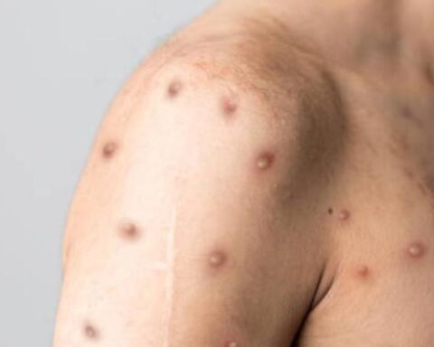 In Colombia, the risk of monkeypox rises to high