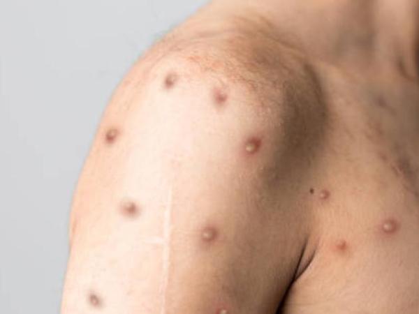 In Colombia, the risk of monkeypox rises to high