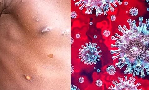 NYC epicentro en USA viruela del mono; se dispara contagio Covid-19