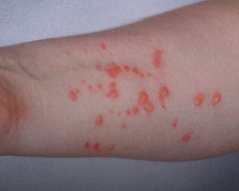 Partially different symptoms in early European cases of monkeypox