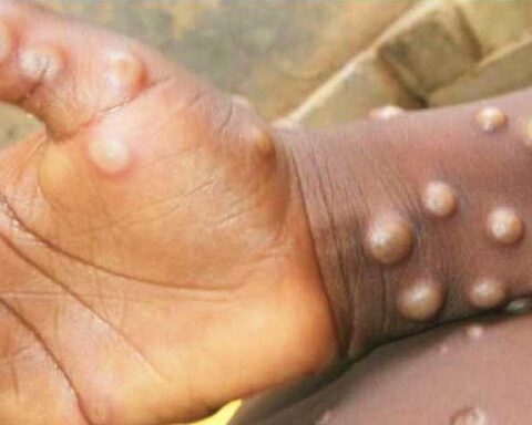 Muestras de los síntomas de la viruela del mono. Foto: OMS / Archivo.