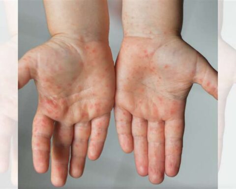 Bolivia registers 63 positive cases of monkeypox