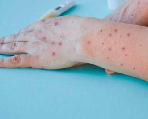 In two weeks Arequipa has 22 cases of monkeypox
