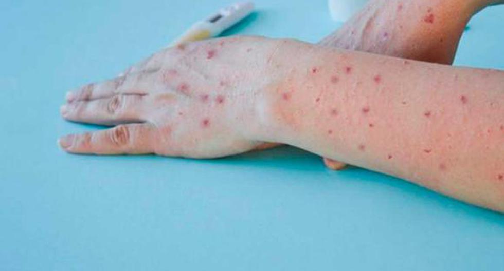 In two weeks Arequipa has 22 cases of monkeypox