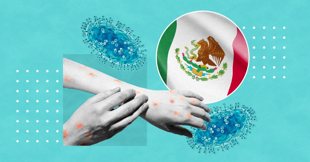 Mexico facing a new risk of health emergency due to monkeypox