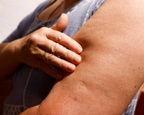 Optimism of the USA in the face of the lower rate of contagion of monkeypox