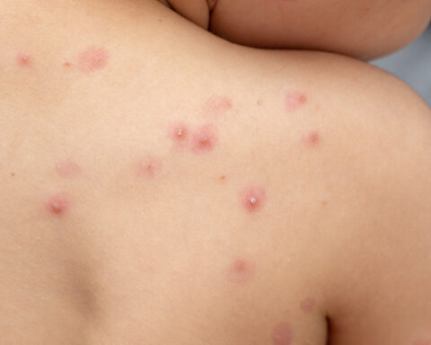 Viruela del mono: Salud Pública investiga otros cinco casos sospechosos