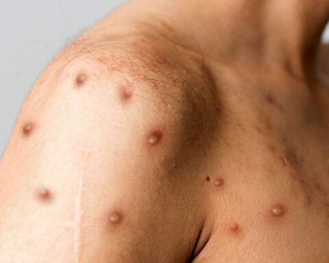 Se registran dos nuevos casos viruela símica en RD