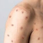 US creates a response group to the spread of monkeypox
