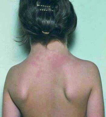 What do we know about Turner Syndrome?  A strange disease that only affects the female sex