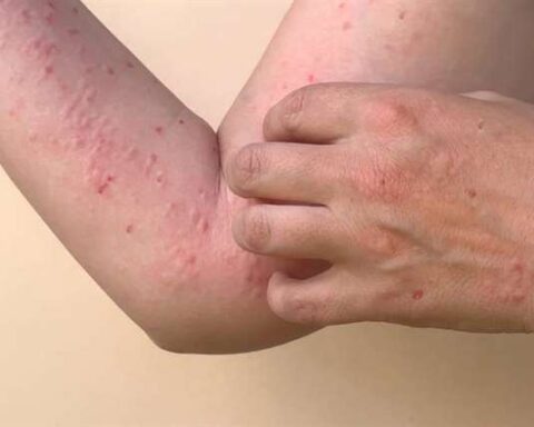 Active cases of monkeypox rise to 93 in the country