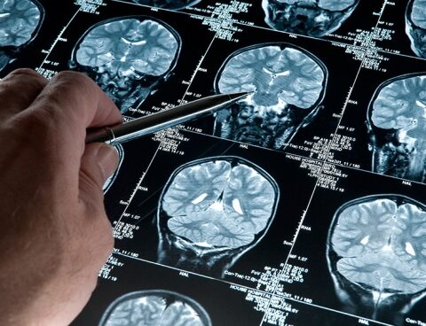 Alzheimer, the disease that can be detected 20 years before the appearance of symptoms