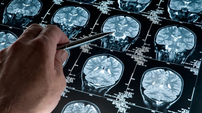 Alzheimer, the disease that can be detected 20 years before the appearance of symptoms