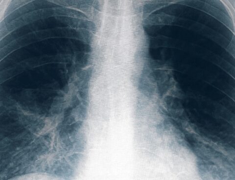 Bilateral pneumonia: another man died in Tucumán